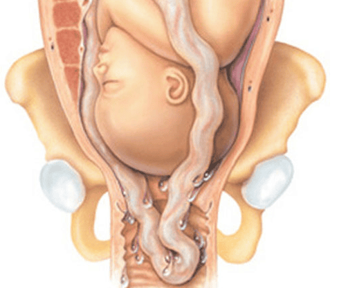 
Trường hợp sa dây rau chống chỉ định thực hiện
