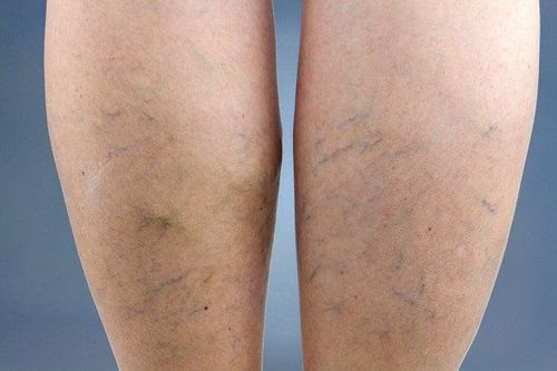 What is the disease of the left calf with zigzag blue veins? Is it worrisome?