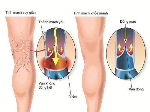 
Bệnh nhân giãn tĩnh mạch chi dưới có cảm giác đau nhói, khó chịu, nặng nề hoặc nóng rát ở chân
