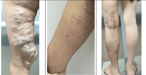 Varicose veins treatment methods