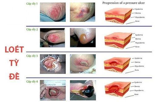 
Các cấp độ ứng với từng giai đoạn của loét do tì đè
