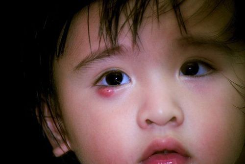 Is it okay for children to develop a patch in their eyes?