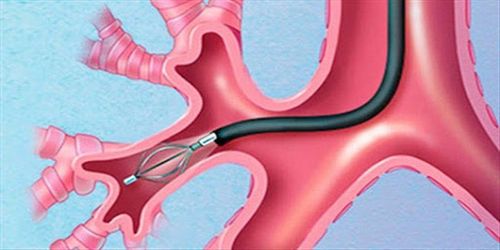 Treatment protocol for scar of hypoglottic stenosis in children