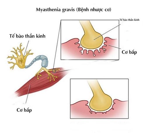 
Bệnh nhược cơ chính là một căn bệnh tự miễn dịch điển hình
