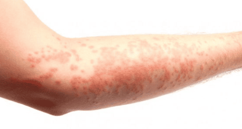 How can eczema lead to asthma?