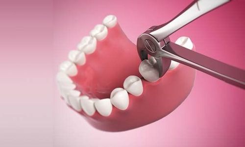 Có nên nhổ răng khi đang hóa trị ung thư hay không?