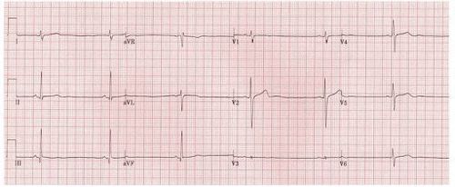 
Nhịp chậm xoang trên hình ảnh điện tâm đồ của người bệnh
