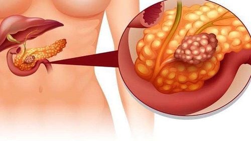 Abdominal drainage in acute pancreatitis