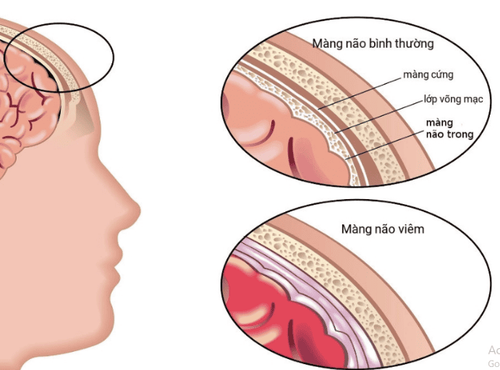 Hội chứng màng não: Dấu hiệu, nguyên nhân và cách điều trị