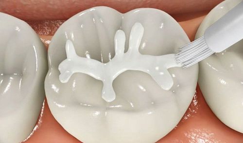 Sealant in dentistry: what you need to know