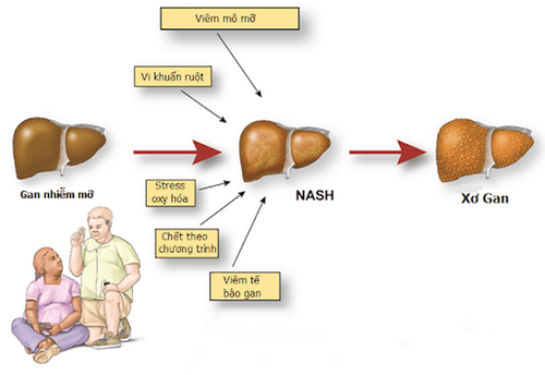 
NASH - Viêm gan nhiễm mỡ không do rượu
