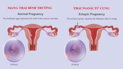 Missed period, tested 2 lines but ultrasound did not see the gestational sac, what should I do?