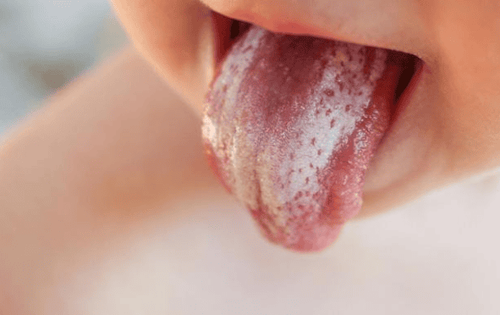 Dấu hiệu nấm miệng ở trẻ sơ sinh là gì?
