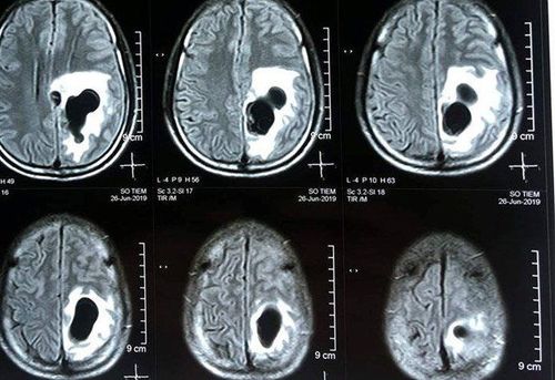 
Hình ảnh người bệnh mắc sán não được phát hiện qua MRI
