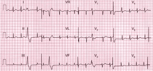 Does mild ectopic heart disease get worse?