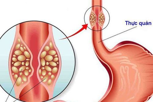 Trào ngược dạ dày tái phát có nguy hiểm không?