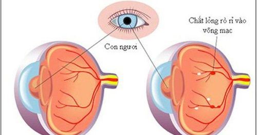 
Võng mạc đái tháo đường gây ảnh hưởng tới cảm nhận ánh sáng nhận diện hình ảnh
