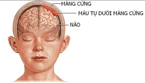 
Máu tụ ngoài màng cứng là biến chứng thường gặp nhất của vỡ sàn sọ
