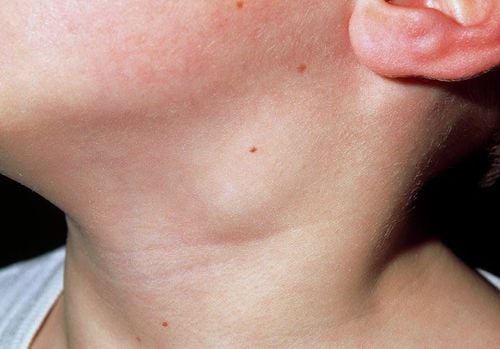 Nổi hạch vùng góc hàm, dưới cằm, nuốt nghẹn và chóng mặt là vì sao?