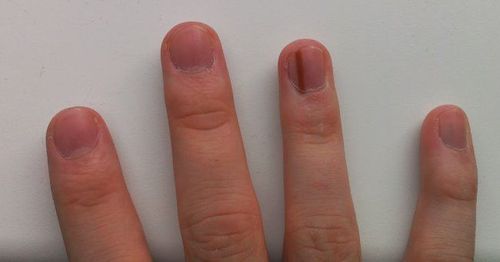 Đường sọc dài màu đen trên móng tay có phải là dấu hiệu ung thư không?