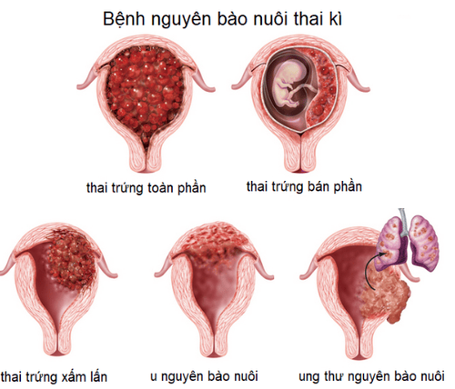 Bệnh nguyên bào nuôi có mấy loại?