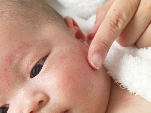 Common skin diseases in babies