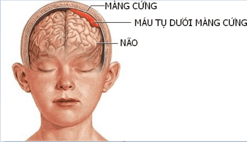 
Hình ảnh mô phỏng tụ máu dưới màng cứng
