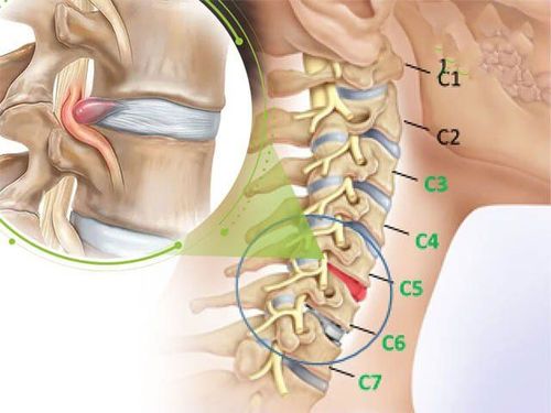 Phẫu thuật cắt chéo thân đốt sống cổ