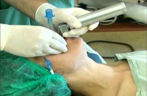 Endotracheal anesthesia for surgical treatment of multiple traumas of the maxillofacial region