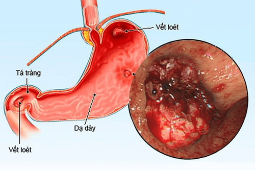 Chỉ định xét nghiệm Gastrin ở bệnh nhân viêm loét dạ dày