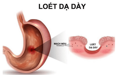 How long does it take to treat stomach ulcers with medicine?