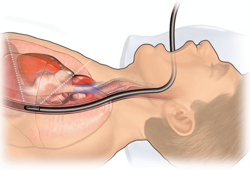 Indications and contraindications for transesophageal echocardiography