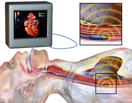 Indications for transesophageal echocardiography