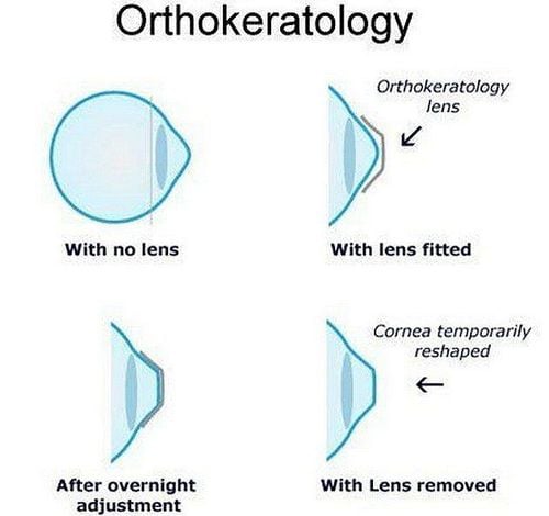 
Kính áp tròng cứng Orthokeratology, Ortho-K được thiết kế đặc biệt và an toàn cho người sử dụng
