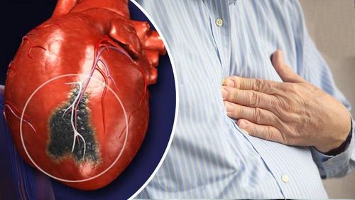 Các lựa chọn điều trị thiếu máu cơ tim