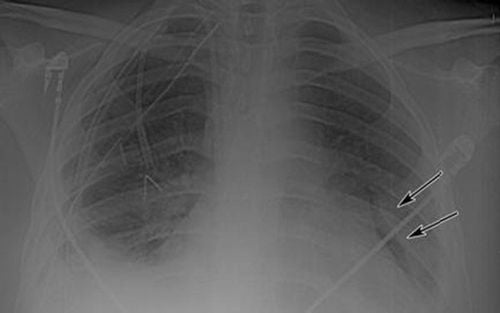 Incomplete interlobular fissure sign on straight chest radiograph