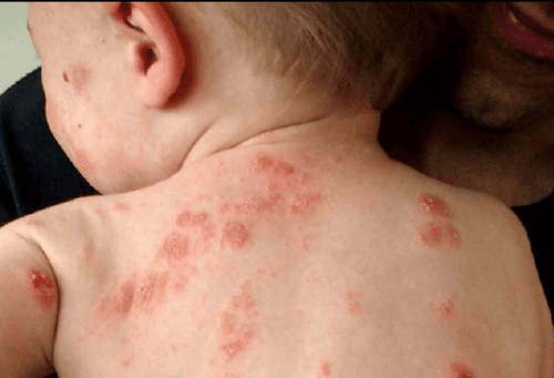 What medicine is used for impetigo?