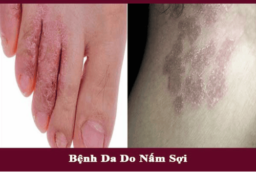 Skin diseases caused by filamentous fungi: Causes, symptoms and treatment