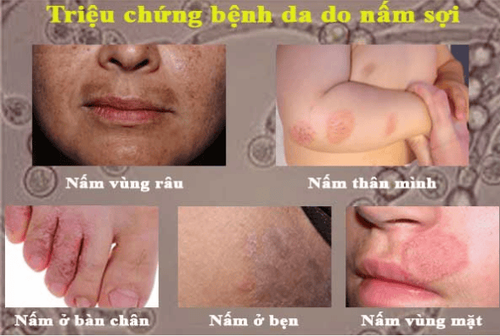 
Bệnh da do nấm sợi thường xuất hiện ở các vùng nhất định trên cơ thể
