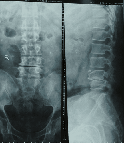 X-ray technique of the lumbar spine