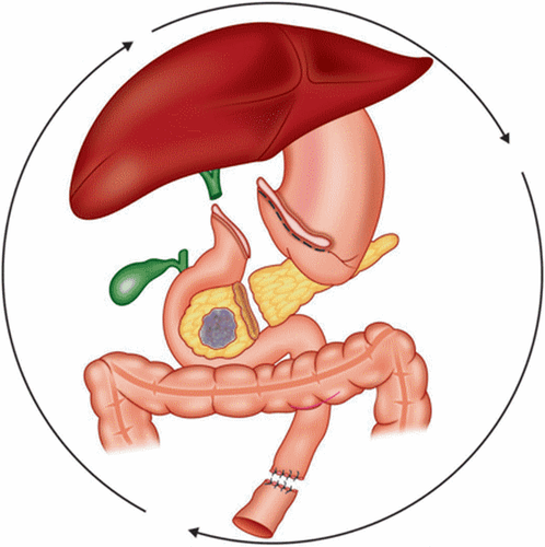 
Lược đồ cắt bỏ khối tá-đầu tuỵ do ung thư
