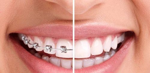 How long does it take for orthodontic treatment to be removed?