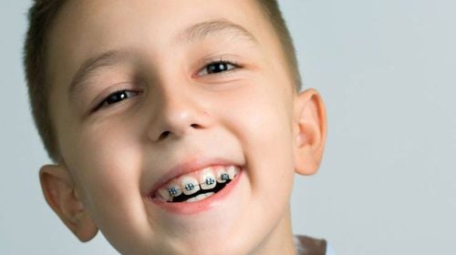 Có nên đeo nẹp răng cho trẻ 9 tuổi không?