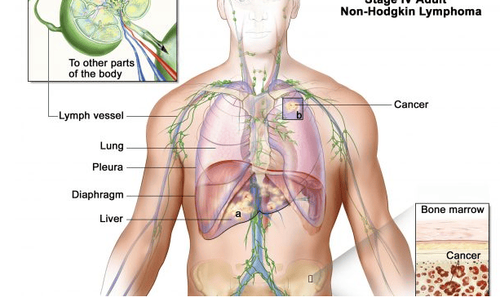 
U lympho Non- Hodgkin là một bệnh máu ác tính
