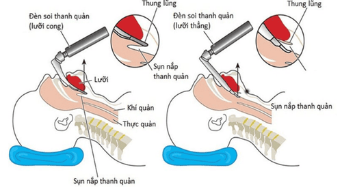 
Gây mê nội khí quản phẫu thuật chỉnh gù vẹo cột sống phù hợp với người bệnh có gù vẹo cột sống cần phẫu thuật chỉnh hình thẩm mỹ
