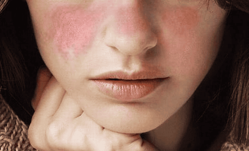 Các triệu chứng lupus ban đỏ điển hình