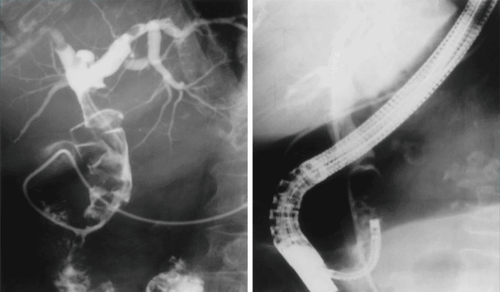 The role of endoscopic retrograde cholangiopancreatography in biliary tract disease