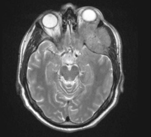 Procedure of magnetic resonance imaging of the orbit and optic nerve with injection of magnetic contrast agent