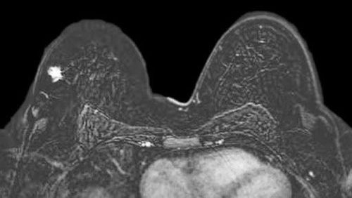 What are the risks of an MRI of the breast?