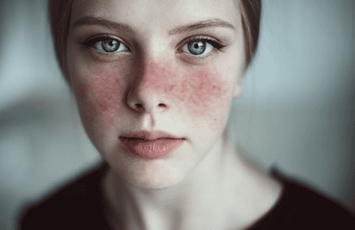 What is systemic lupus erythematosus? How dangerous?